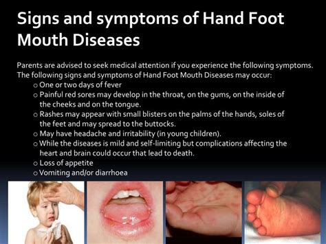 Hand Foot And Mouth Disease PPT