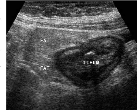 Detection of ileocecal Crohn’s disease using ultrasound as the primary ...