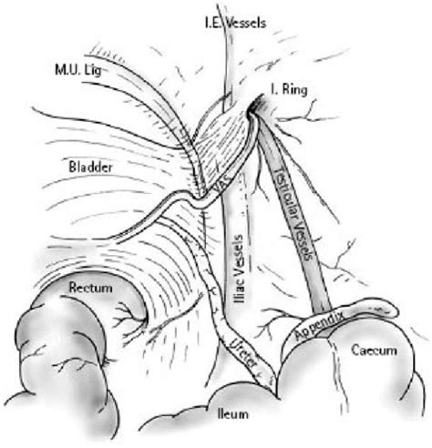 Laparoscopic Fowler Stephens Orchiopexy The Westchester Medical Center