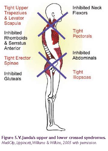 Very Effective Fitness Training Upper And Lower Crossed Syndrome