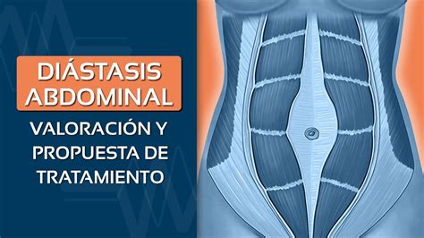 Valoración y tratamiento diástasis abdominal 2020 mDurance