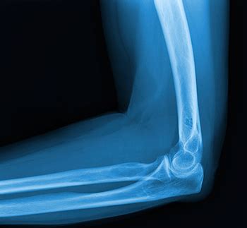 Elbow Sprain Chandler, AZ | Casa Grande | Hip Fracture Mesa, Queen Creek