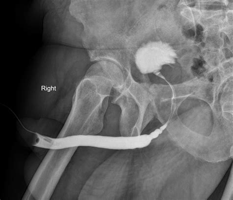 Bulbar Urethral Stricture Image Radiopaedia Org