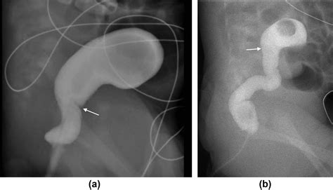 Diagnostic Decision Making Tool For Imaging Term Neonatal Bowel