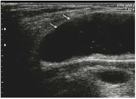 Non-thrombotic Abnormalities on Lower Extremity Venous Duplex ...