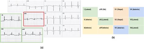 Figure 1 From Autonomous Myocardial Infarction Detection From