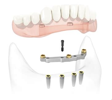 Protesi Mobile Con Barra Su Impianti Implantologia Dentale L Aquila