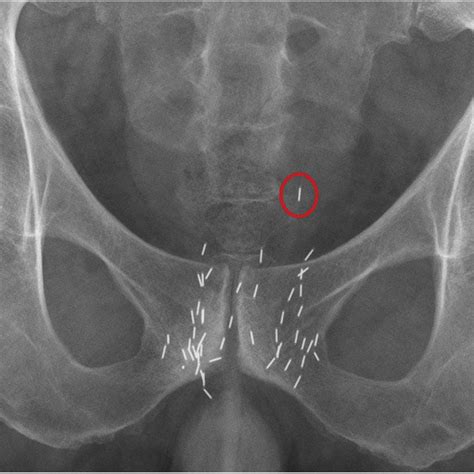 Seed Migration To The Pelvis Pelvic X Ray 3 Years After Implantation Download Scientific