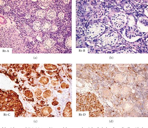 [pdf] Intra Abdominal Testicular Seminoma In A Woman With Testicular