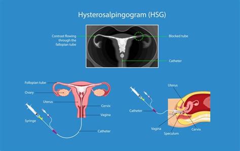 Fallopian Tube Anatomy Hsg