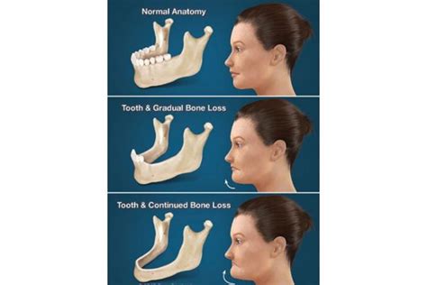 Hidden Consequences Of Losing Teeth Adam R Pershing Dmd