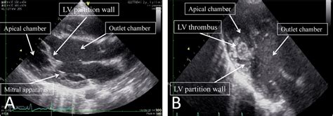 Preoperative Echocardiography A At Admission B 10 Days After