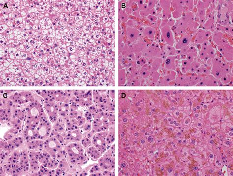 Hepatic Adenomas Surgical Pathology Clinics