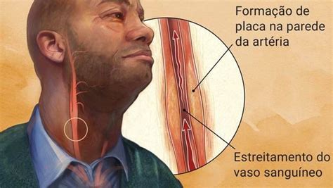 Arteriosclerose O Que Causas Sintomas E Tratamentos Dicas De