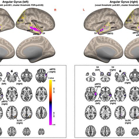 Voxel Level Connectivity Map Of Left Posterior Middle Temporal Gyrus