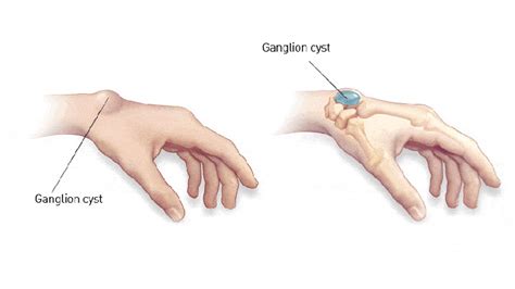 Ganglion Cysts Symptoms Causes Diagnosis And Treatment Page 5