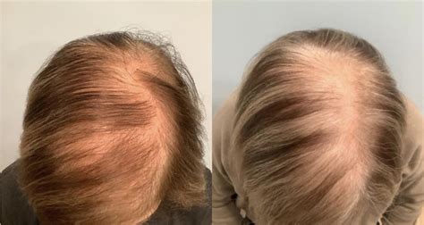 Hair Restoration Before After Photos Patient 49 Washington DC MI