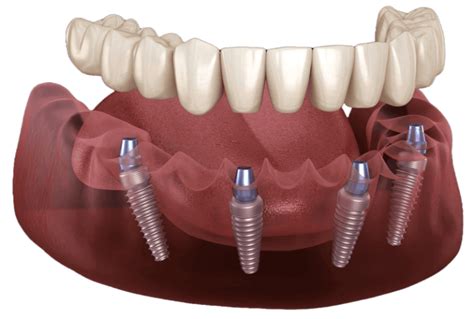 Premier Dental Implants In Tampa Tampa Implant Clinic