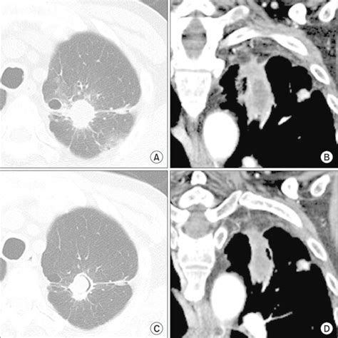 Enhanced Chest Computed Tomography Ct Findings A B Chest Ct On