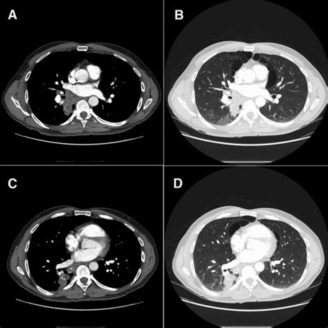 Ct Chest With Corresponding Mediastinal And Lung Windows Showing