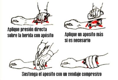 Como Detener Una Hemorragia Guia Sobre Primeros Auxilios