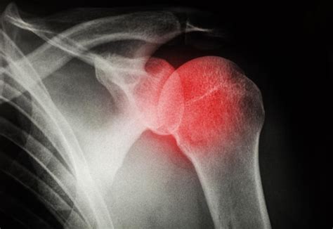 Premium Photo | X-ray of the shoulder