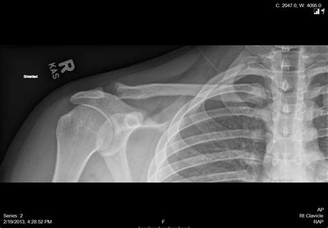 Distal Clavicle Osteolysis - Shoulder & Elbow - Orthobullets