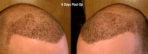 Fue Healing Photos And Result Pictures Alvi Armani Hair Transplant Los Angeles