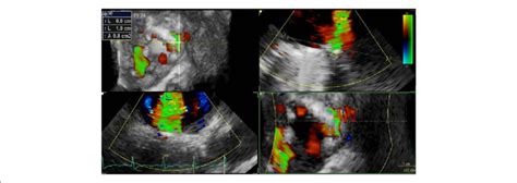 Three Dimensional Transesophageal Echocardiography Demonstrating