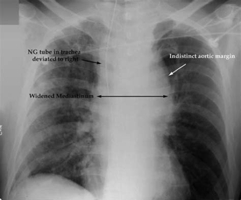 Acute Chest Trauma Flashcards Quizlet