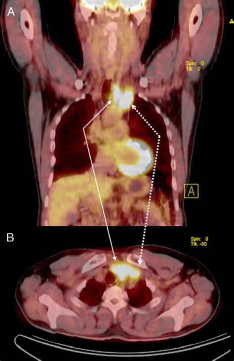 A Year Old Man With A History Of Thyroid Cancer Underwent Fdg Pet Ct