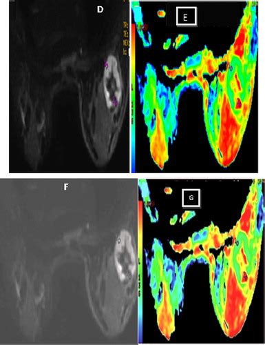 Full Article Role Of MRI In Differentiating Benign From Malignant