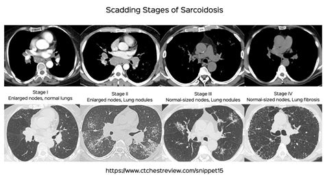 Sarcoidosis Lung Stages