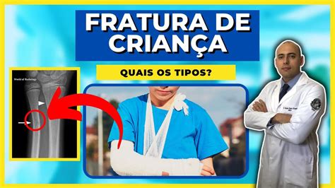 FRATURA DE CRIANÇA SAIBA QUAIS SÃO OS TIPOS E QUAL O TRATAMENTO