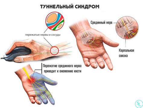 Немеют пальцы на руках причины онемения мизинца большого и безимянного на правой и левой руке