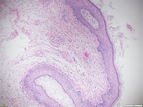 Fibroepithelial Polyp Histology