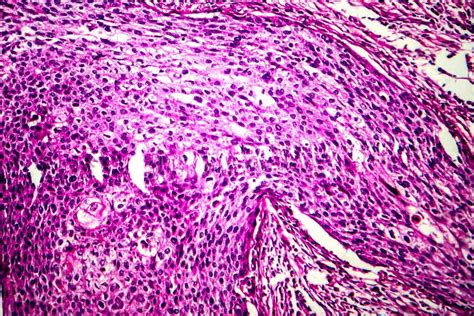 Carcinoma De C Lulas Escamosas De La Micrograf A De La Luz Del Tero