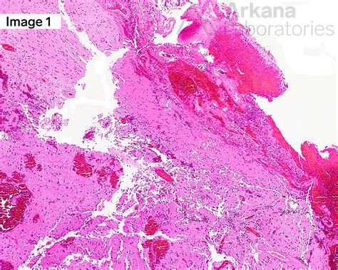 Cerebral Amyloid Angiopathy | Neuro Notes | Arkana Laboratories