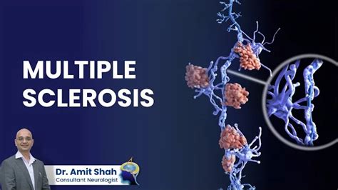 Understanding Multiple Sclerosis Causes Symptoms Diagnosis And