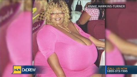 Womans Breasts Weigh 89 Pounds Cnn 2023