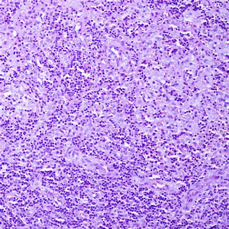 Figure2hematoxylin And Eosin Staining Specimens Of A Lymph Node