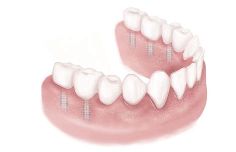 Dental Implants Preserve Bone The Dental Implant Guide