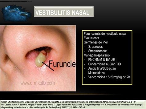 Nasal Vestibulitis - Nasal vestibulitis causes, symptoms, complications ...