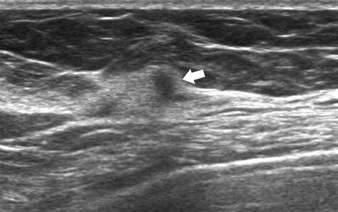 Asymmetric Mammographic Findings Based On The Fourth Edition Of Bi Rads