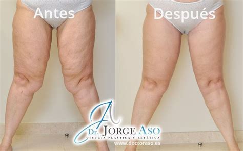 Fotos De Lifting Ded Muslos Antes Y Despu S Dr Aso