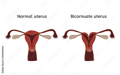 Heart Shaped Becornuate Uterus Womb Uterine Abnormalities