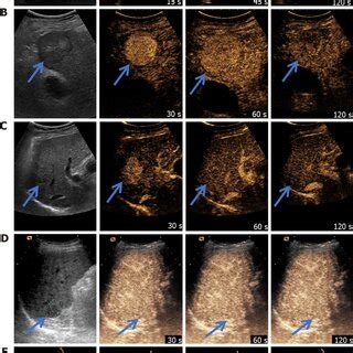 Examples Of Different Contrast Enhanced Ultrasound Liver Imaging