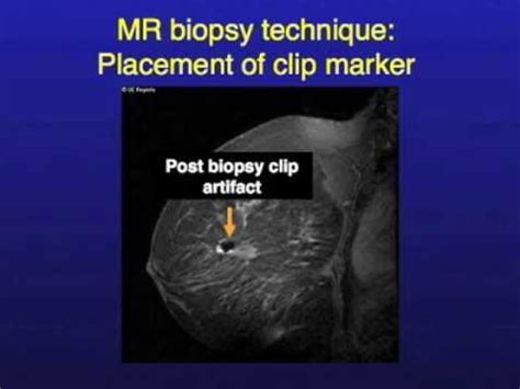 UCSF Radiology How MRI Image Guided Breast Biopsies Are Done YouTube