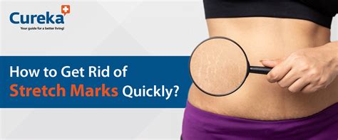 How To Get Rid Of Stretch Marks Quickly