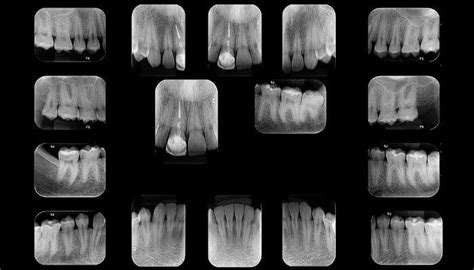 Radiografia Periapical Fenelon